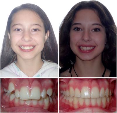 How to Get Rid of an Unsightly Overbite for Good, Byte®